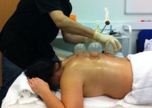 fire cupping therapy casstastrophe